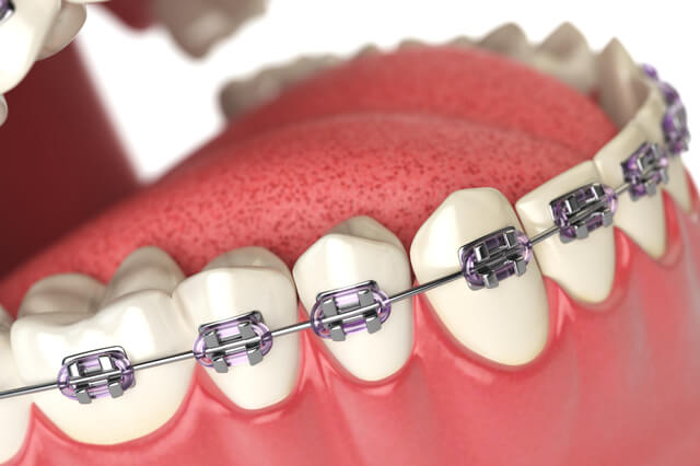 矯正歯科治療の種類